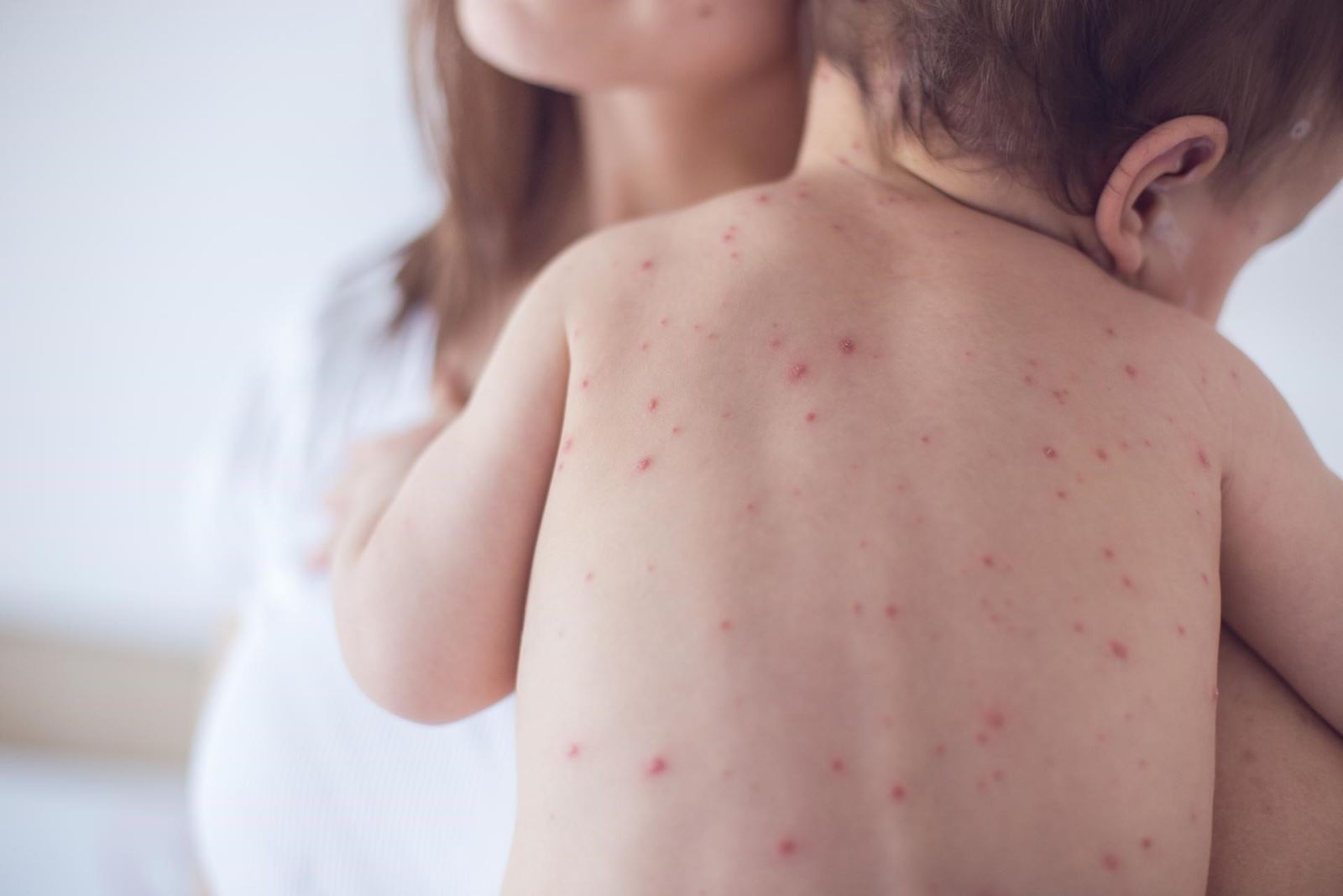 Trẻ bị sốt phát ban và những điều mẹ cần lưu ý
